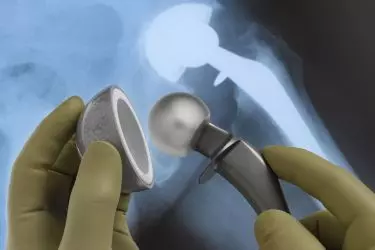 best hospital for hip replacement surgery in madhepura, best doctor for hip replacement surgery in madhepura, cost of hip replacement surgery in madhepura